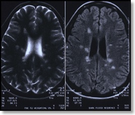 MS-cranial MRI