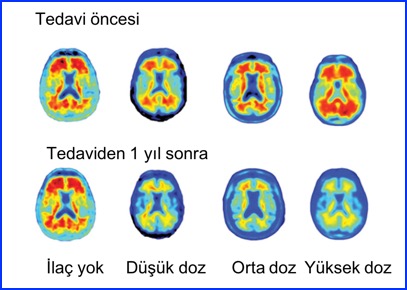 aducunamab kullanan hastalarda takipte beyin PET